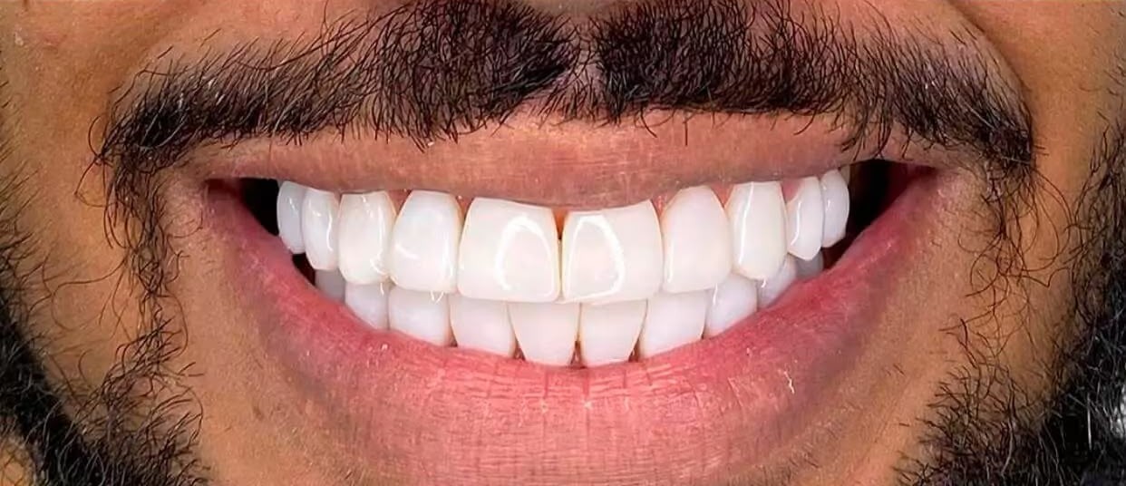 Facetas — depois